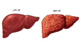 الكشف عن فيروس الكبد الوبائي عبر البول