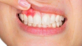 10 مؤشرات لأمراض اللثة لا تتجاهلها