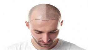 5 عوامل تؤدي إلى فشل زراعة الشعر