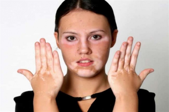 ترخيص أول دواء منزلي للبهاق.. يعيد الجلد لطبيعته
