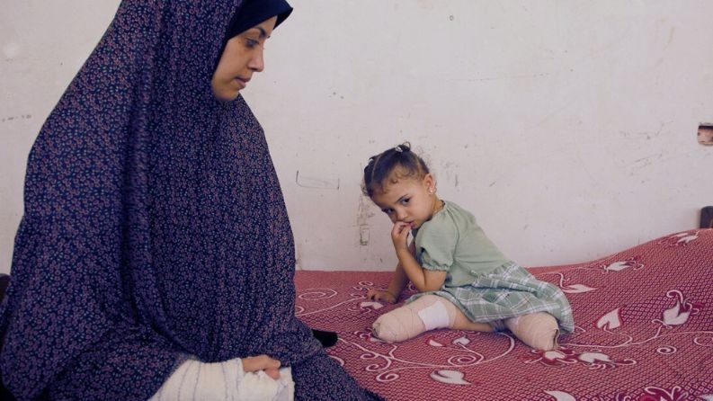 غزة موطنُُ لأكبر مجموعة من الأطفال مبتوري الأطراف