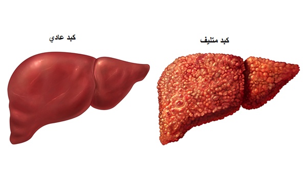 الكشف عن فيروس الكبد الوبائي عبر البول