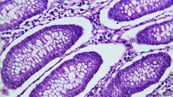 علماء ينجحون في تشخيص سرطان الأمعاء في أقل من ثانية!