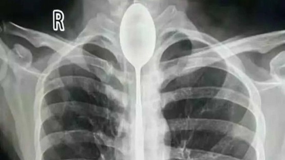 ابتلع ملعقة وحدث ما لا يمكن تصوره