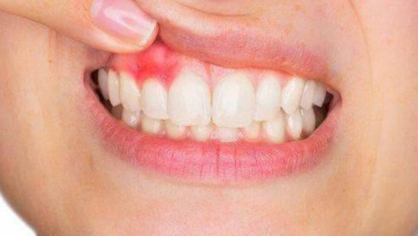 10 مؤشرات لأمراض اللثة لا تتجاهلها