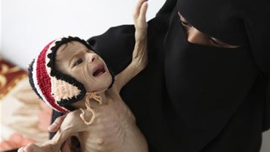 مسؤول أممي: الجوع ينتصر في اليمن