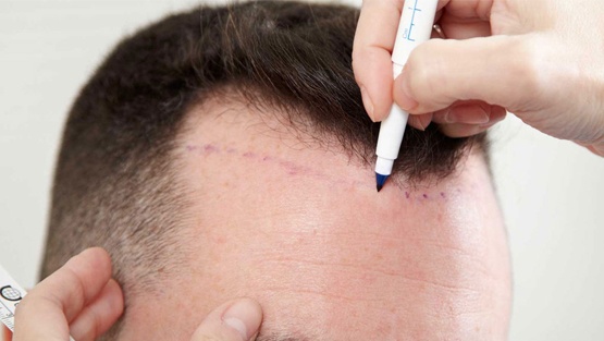 في الهند: وفاة شخص في عملية زراعة شعر
