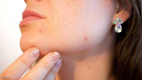 أغذية تسرع ظهور حب الشباب